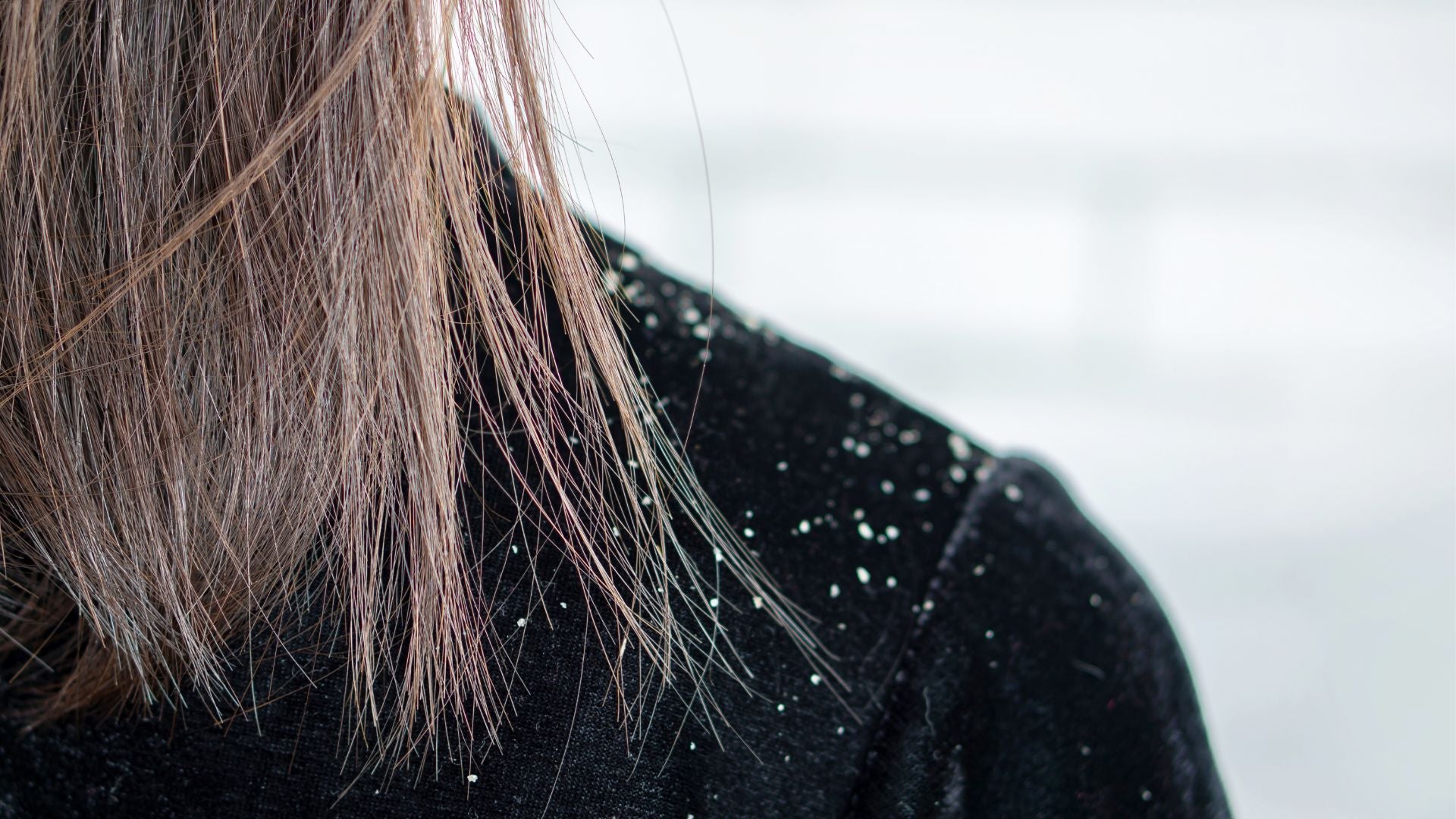 Don’t Flake Out This Winter: Sleep on Silk to Manage Dandruff and Dry Scalp